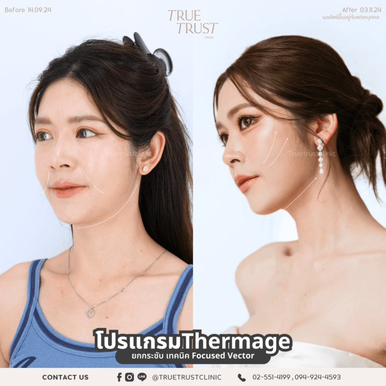 thermage