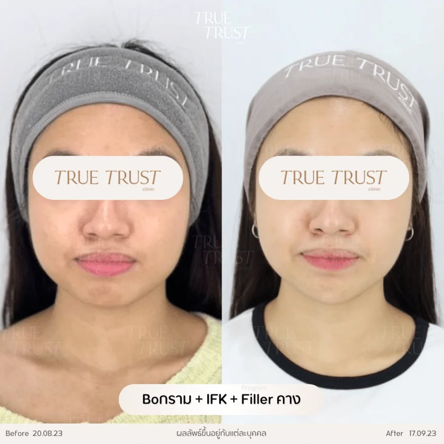 รีวิวฟิลเลอร์22