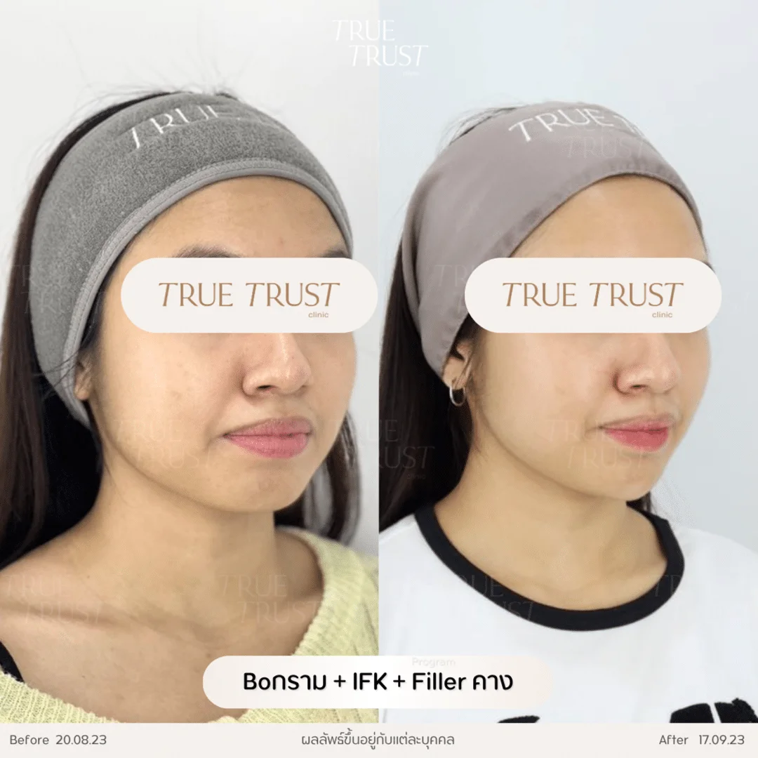 รีวิวฟิลเลอร์23