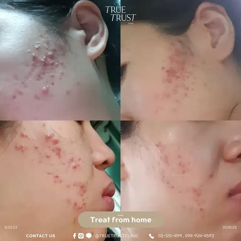 acne_review