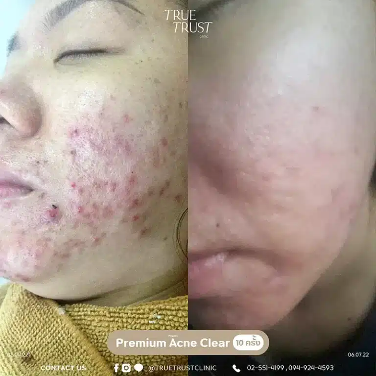 acne_review10