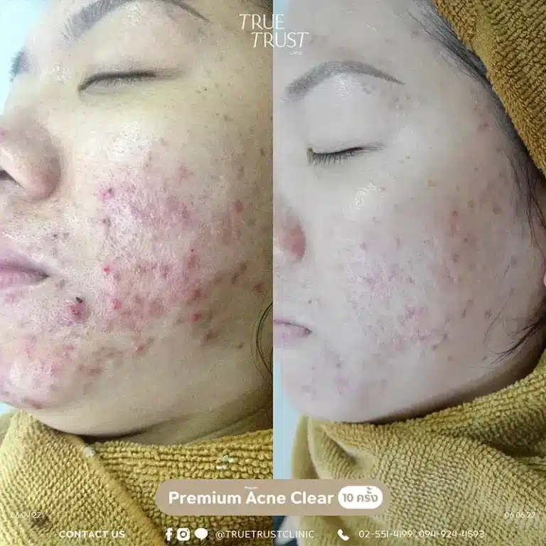 acne_review11