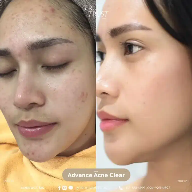 acne_review12