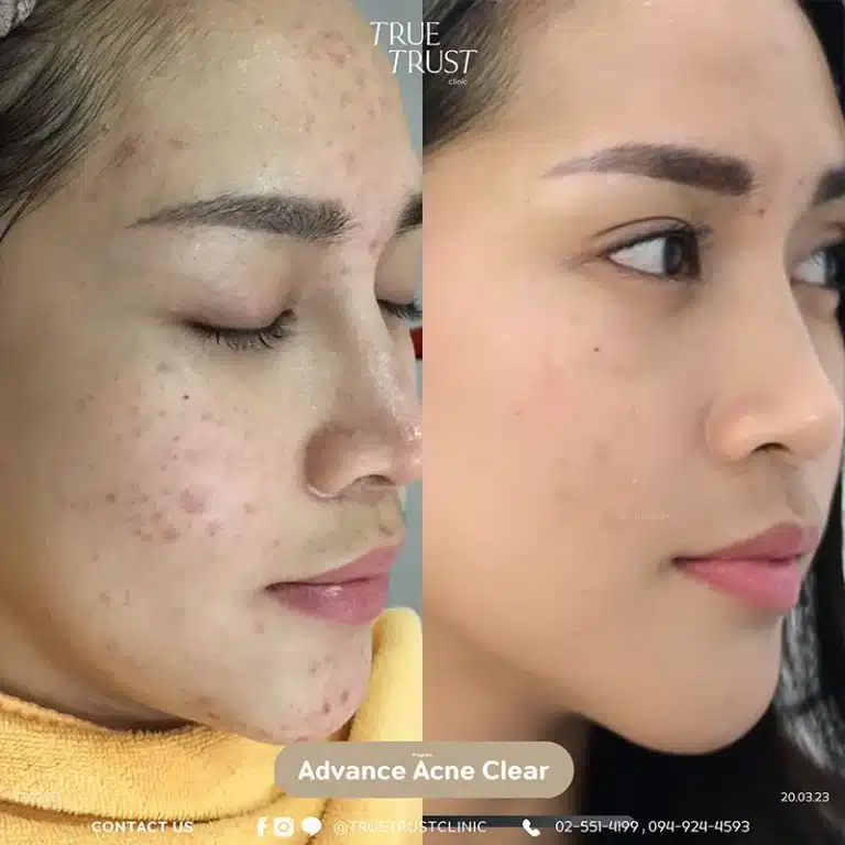 acne_review13