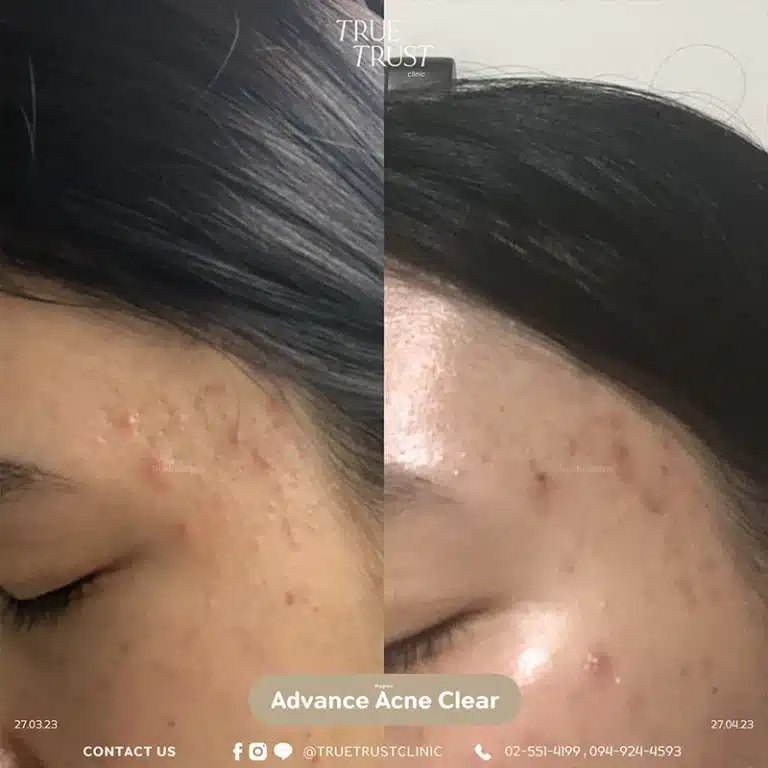 acne_review14