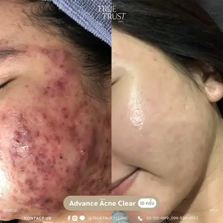 acne_review15