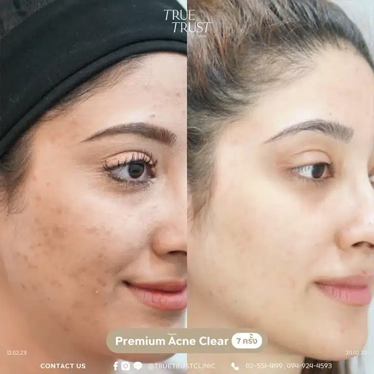 acne_review2