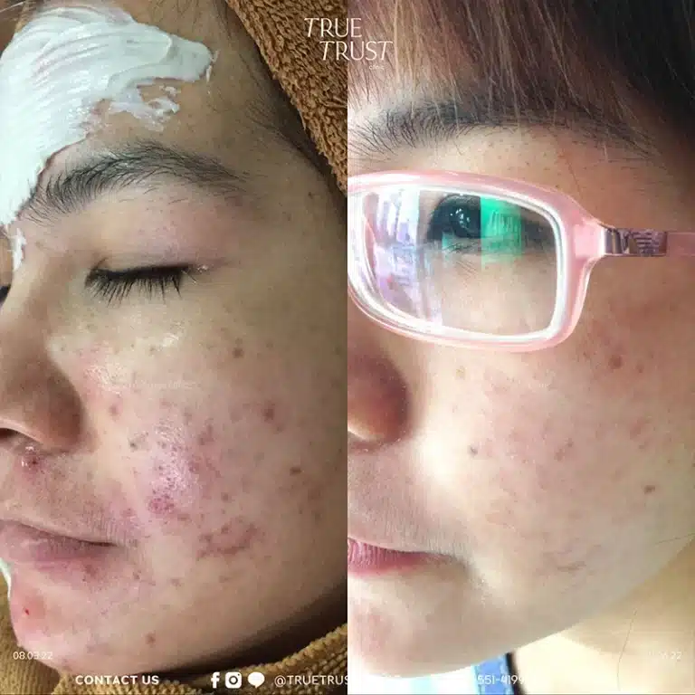 acne_review3