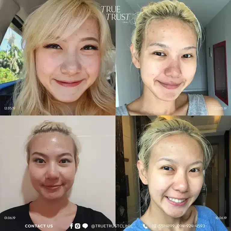 acne_review4