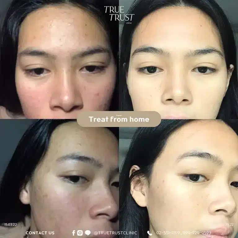 acne_review5