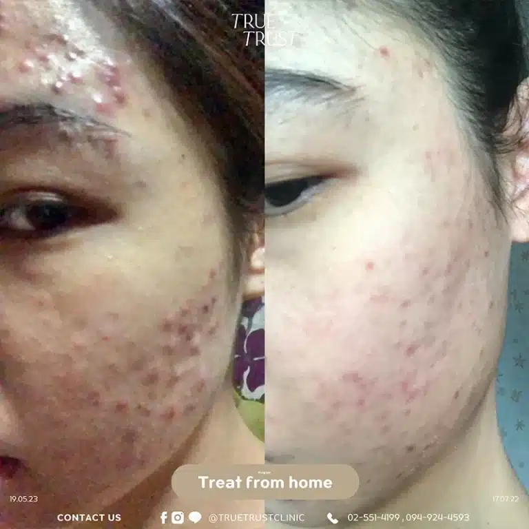 acne_review6