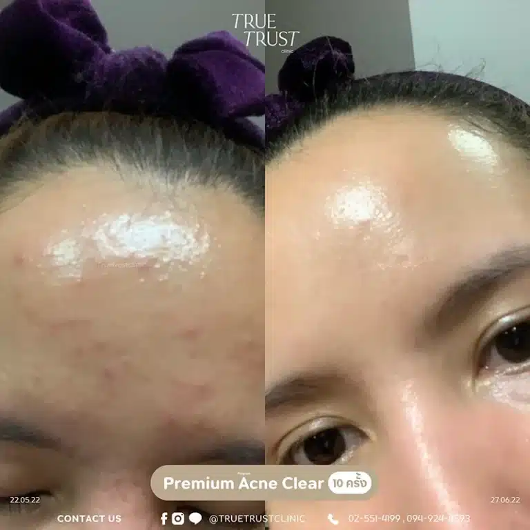 acne_review8
