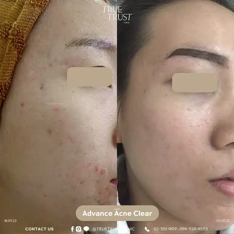 acne_review9