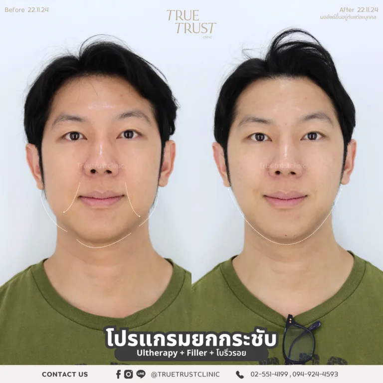 ฟิลเลอร์