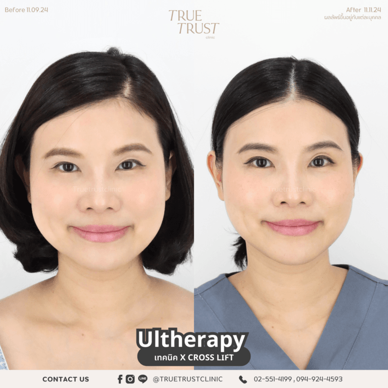 ulthera