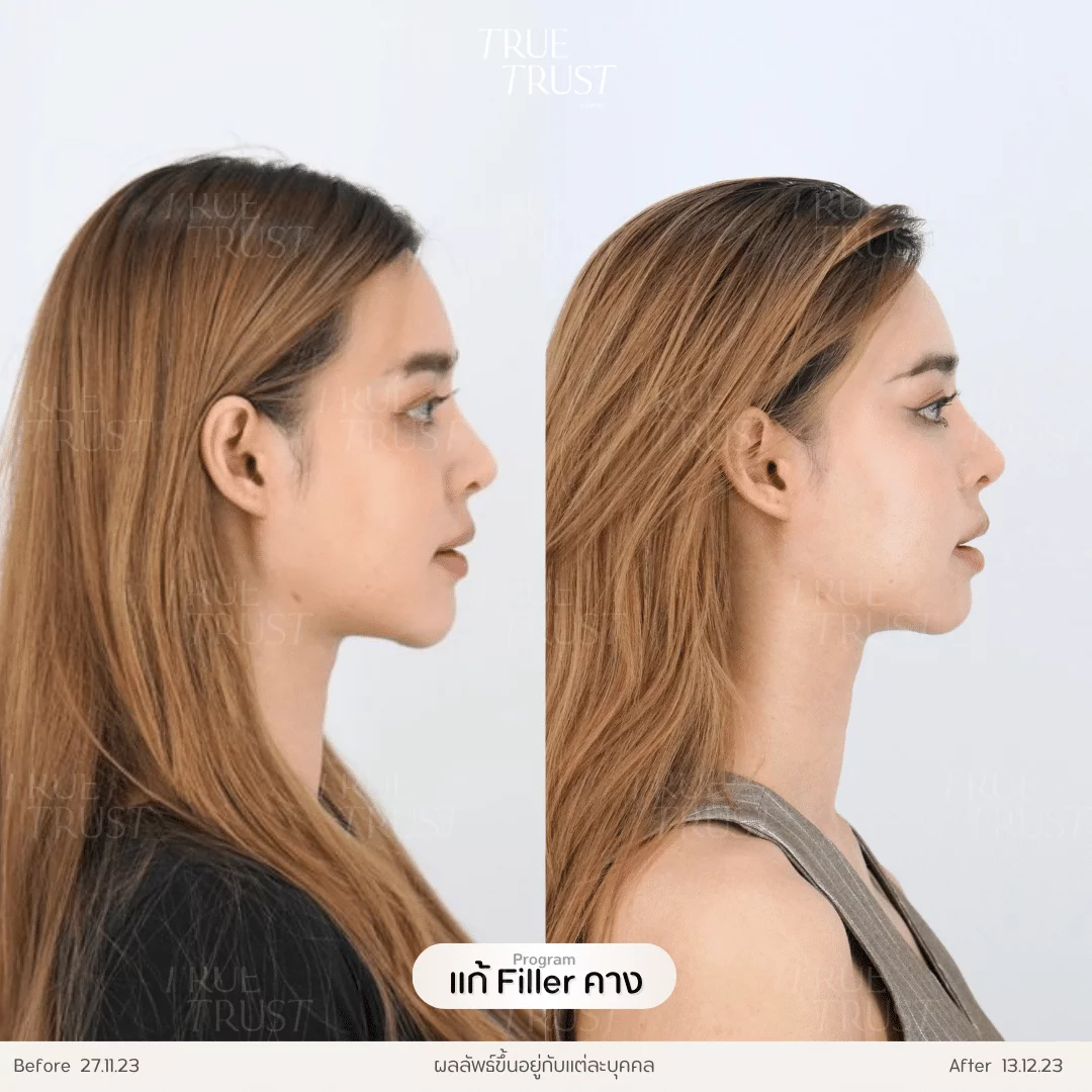 ฟิลเลอร์คาง