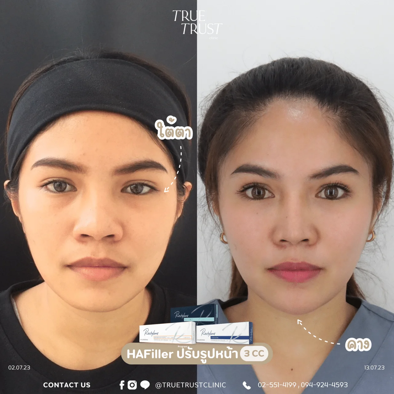 รีวิวฟิลเลอร์คาง