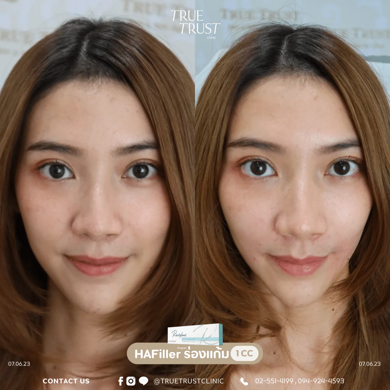 รีวิวฟิลเลอร์ร่องแก้ม