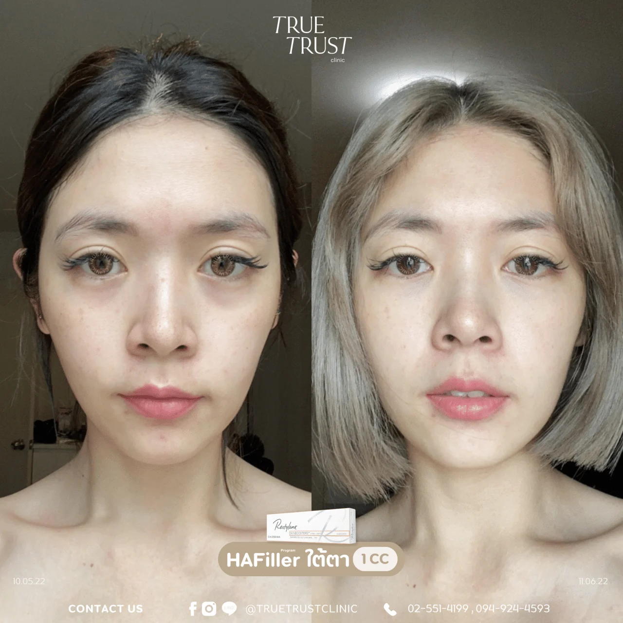 รีวิวฟิลเลอร์ใต้ตา