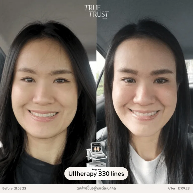 รีวิว Ulthera