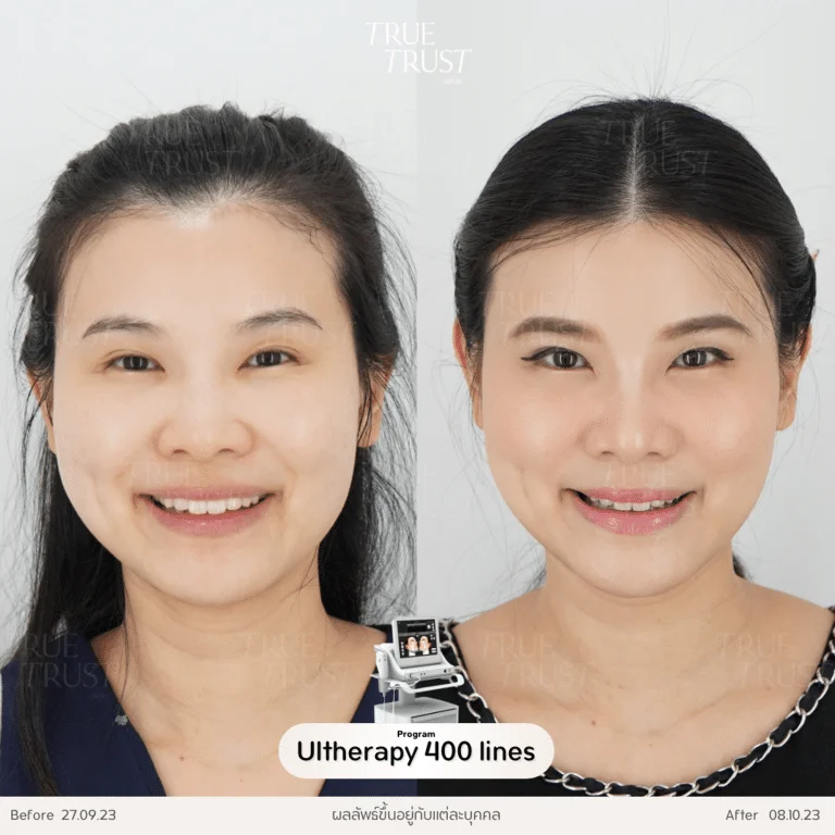 รีวิว ulthera 02