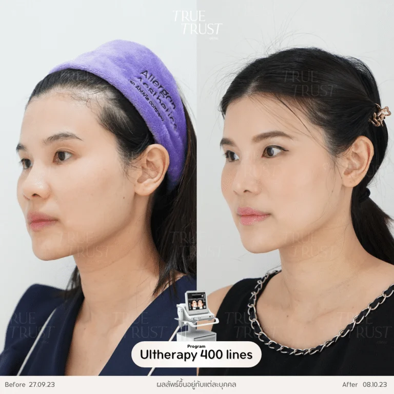 รีวิว ulthera 03