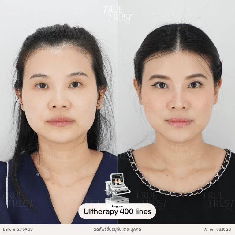 รีวิว uthera 03