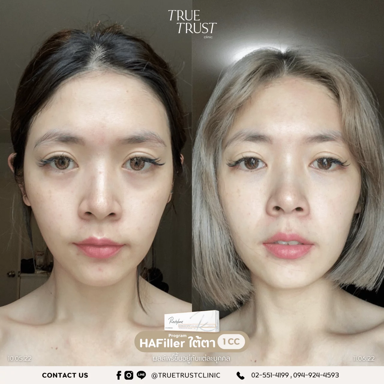 รีวิวฟิลเลอร์1