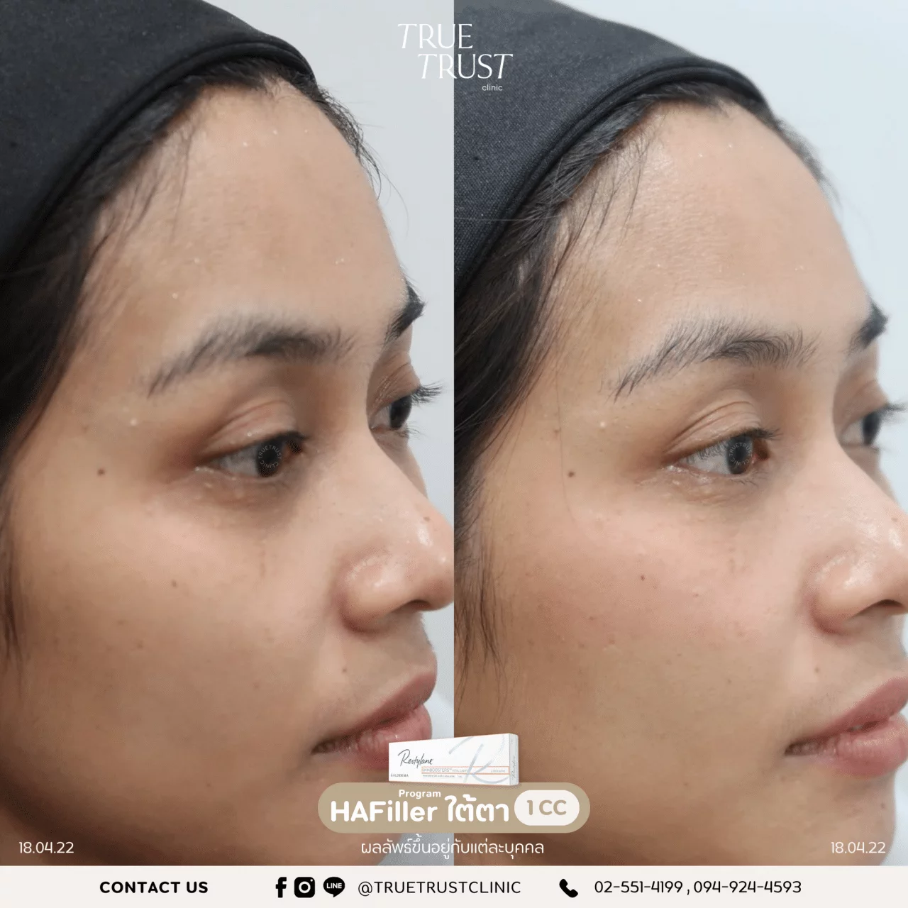 รีวิวฟิลเลอร์11