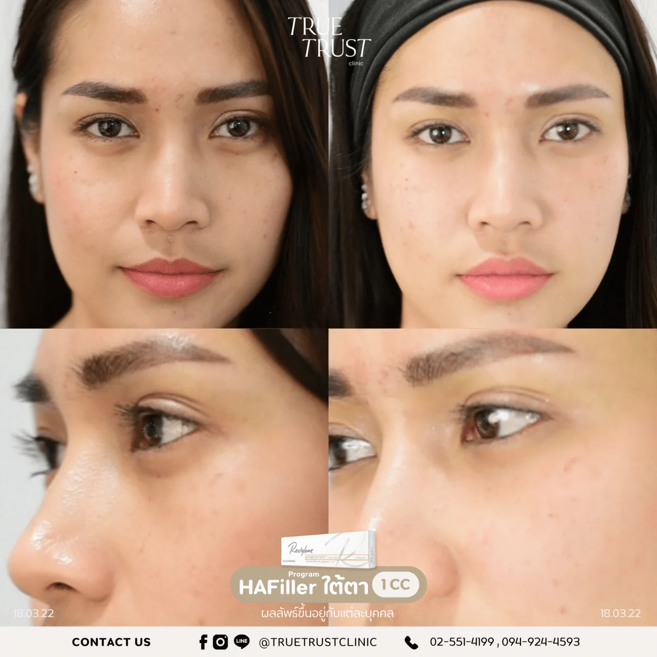 รีวิวฟิลเลอร์12