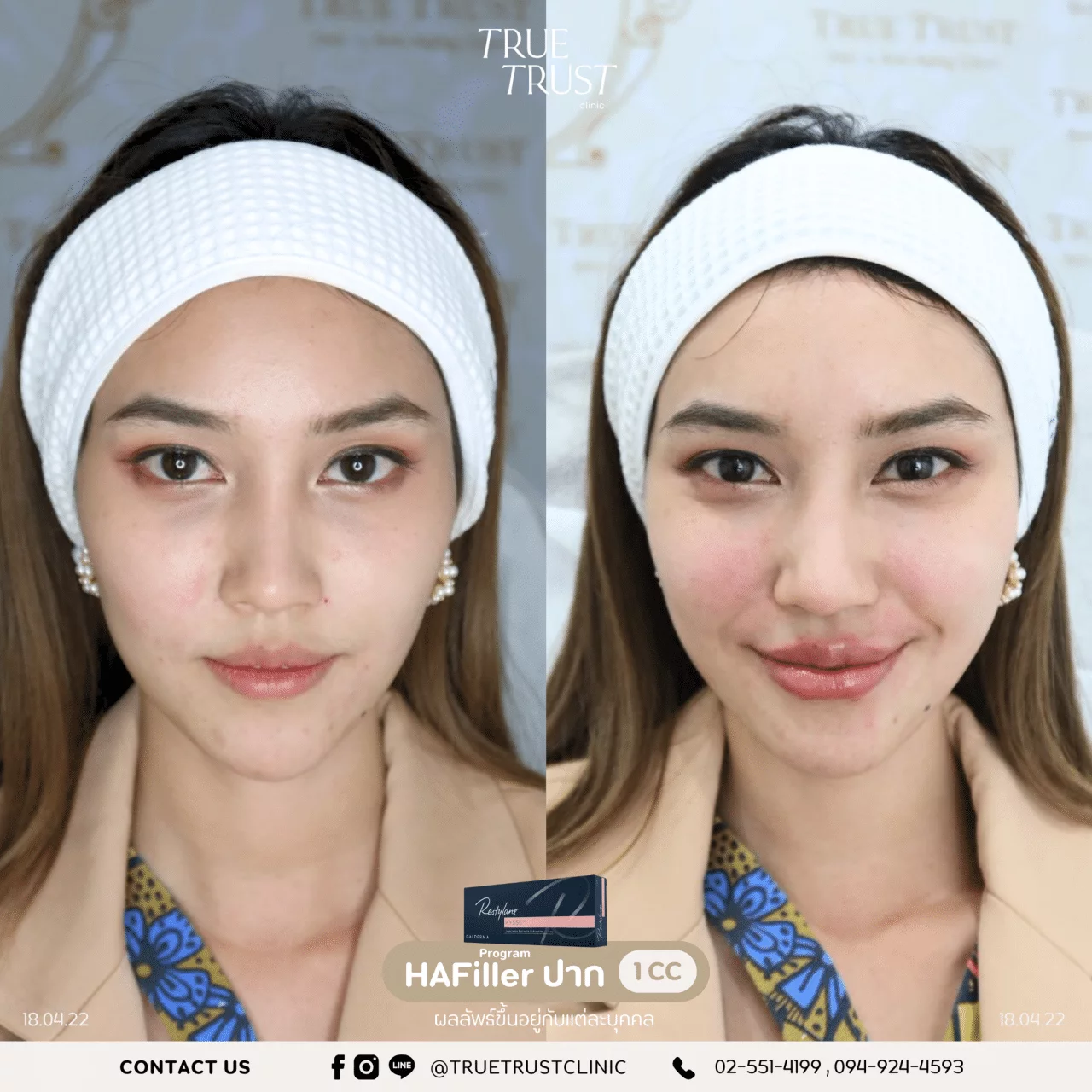 รีวิวฟิลเลอร์14