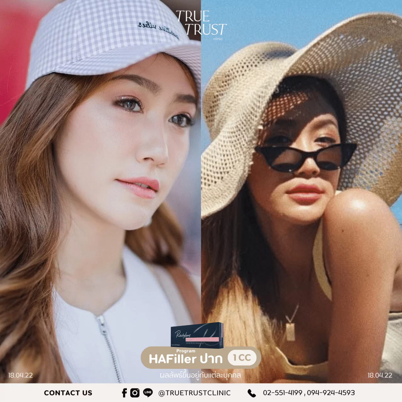 รีวิวฟิลเลอร์15