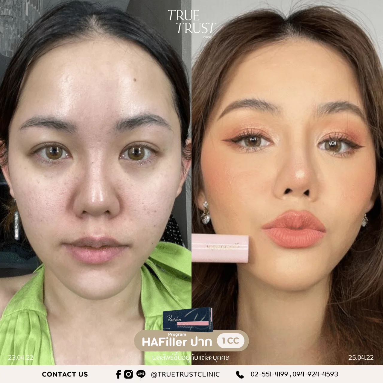 รีวิวฟิลเลอร์16