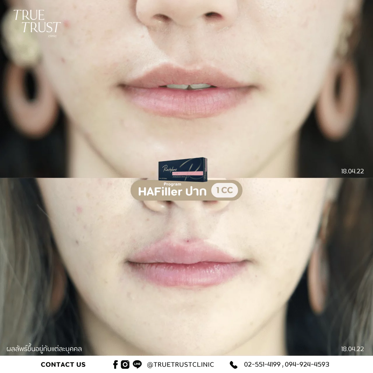 รีวิวฟิลเลอร์17