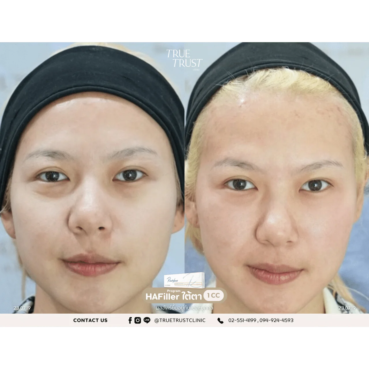 รีวิวฟิลเลอร์18