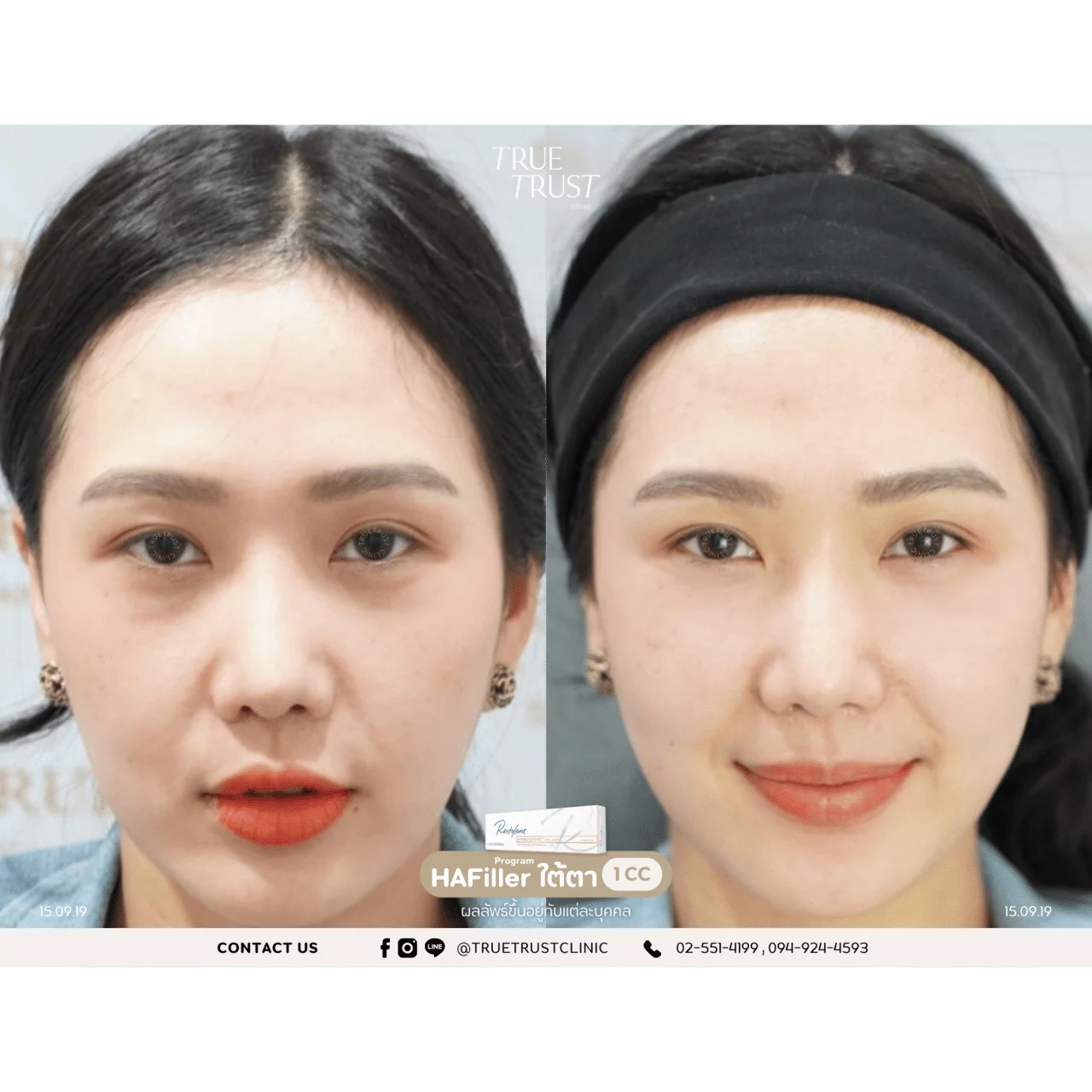 รีวิวฟิลเลอร์19