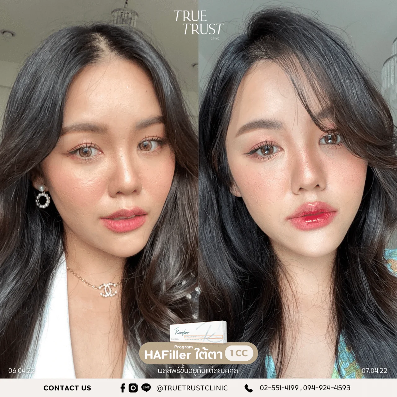 รีวิวฟิลเลอร์2