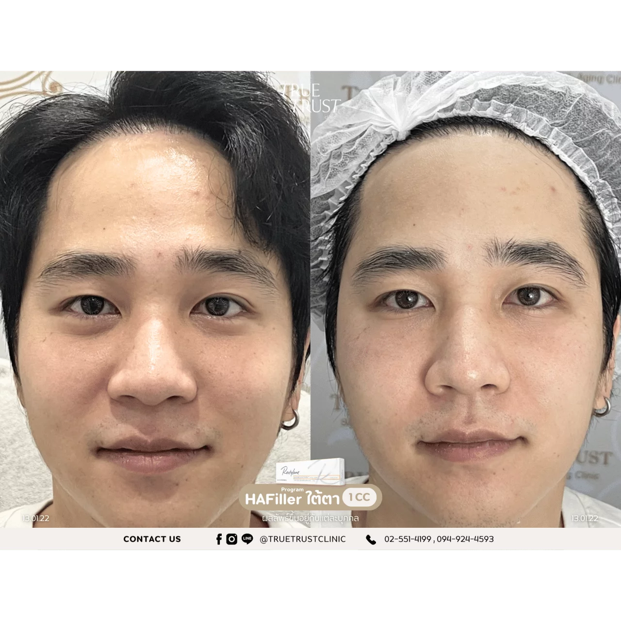 รีวิวฟิลเลอร์20