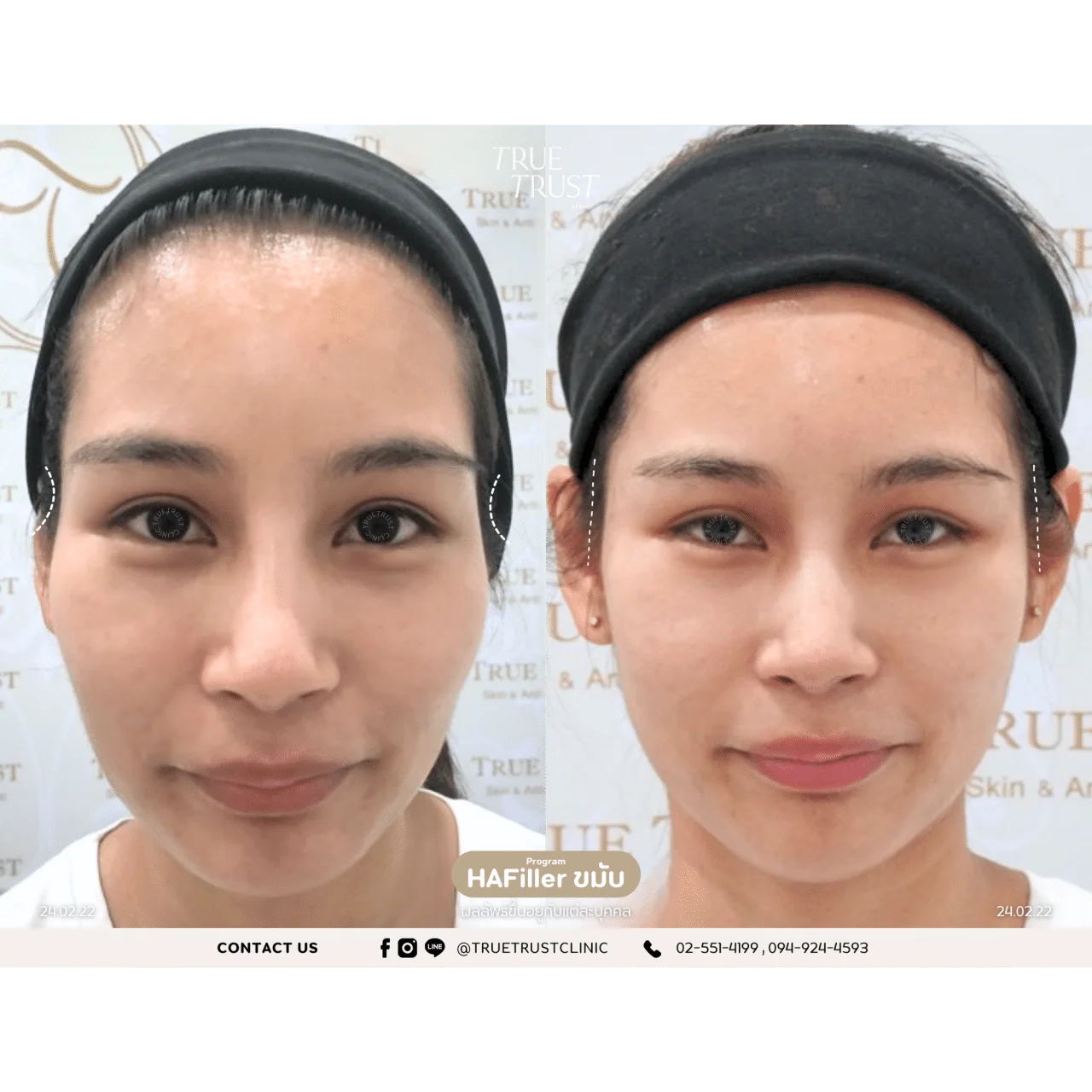 รีวิวฟิลเลอร์21