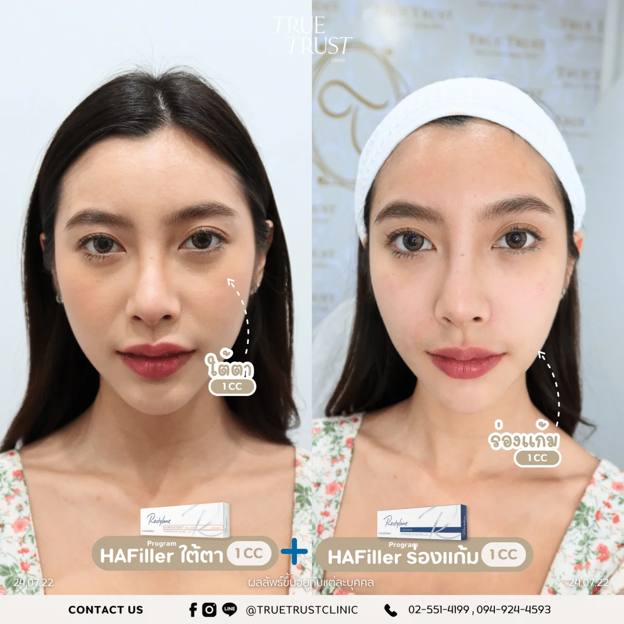 รีวิวฟิลเลอร์4