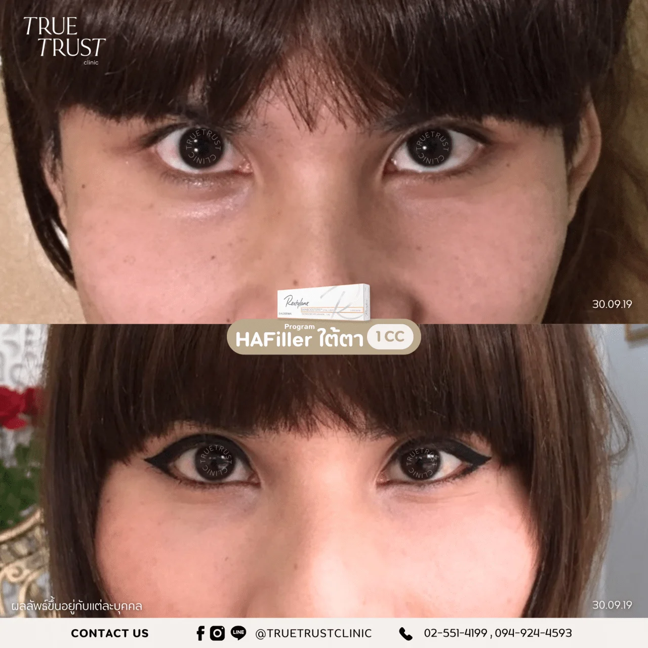 รีวิวฟิลเลอร์5