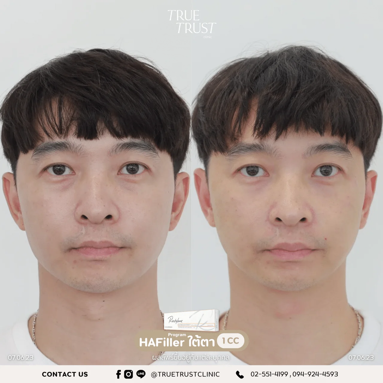 รีวิวฟิลเลอร์6