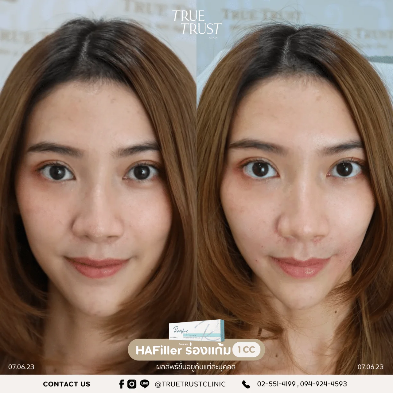 รีวิวฟิลเลอร์7