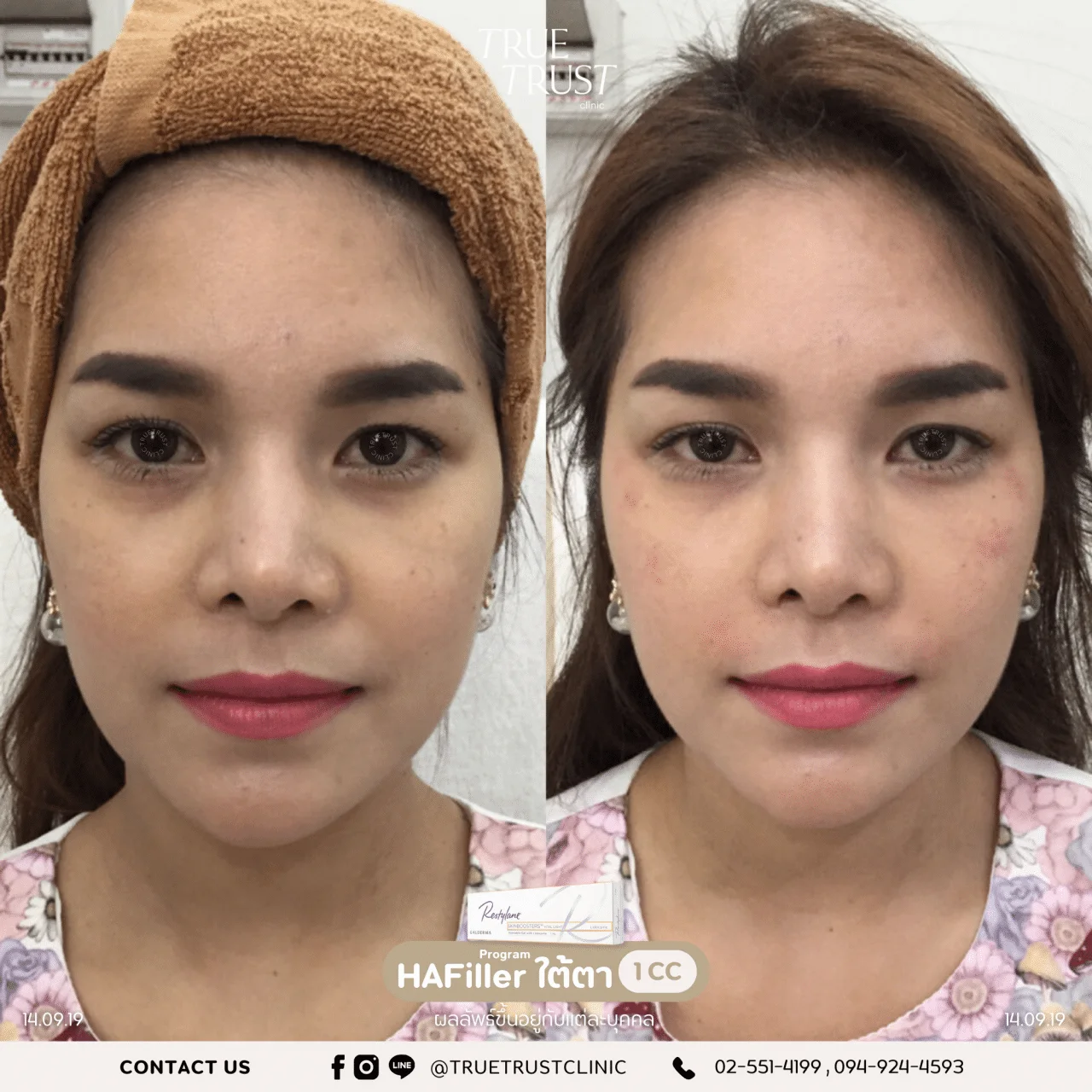 รีวิวฟิลเลอร์8