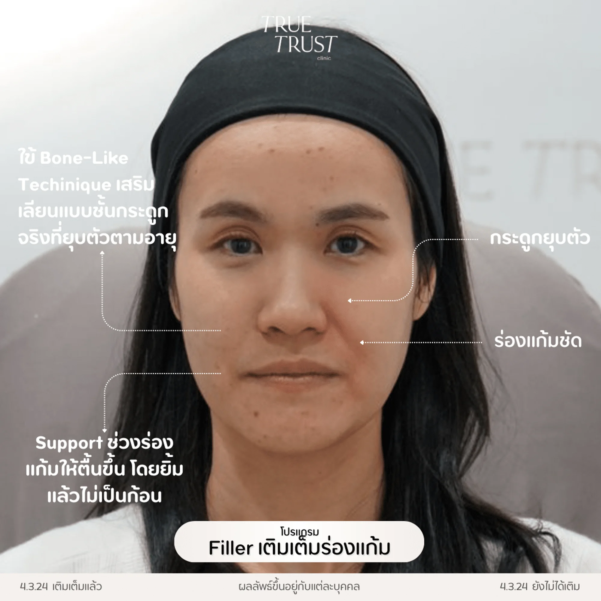 รีวิวฟิลเลอร์ร่องแก้ม