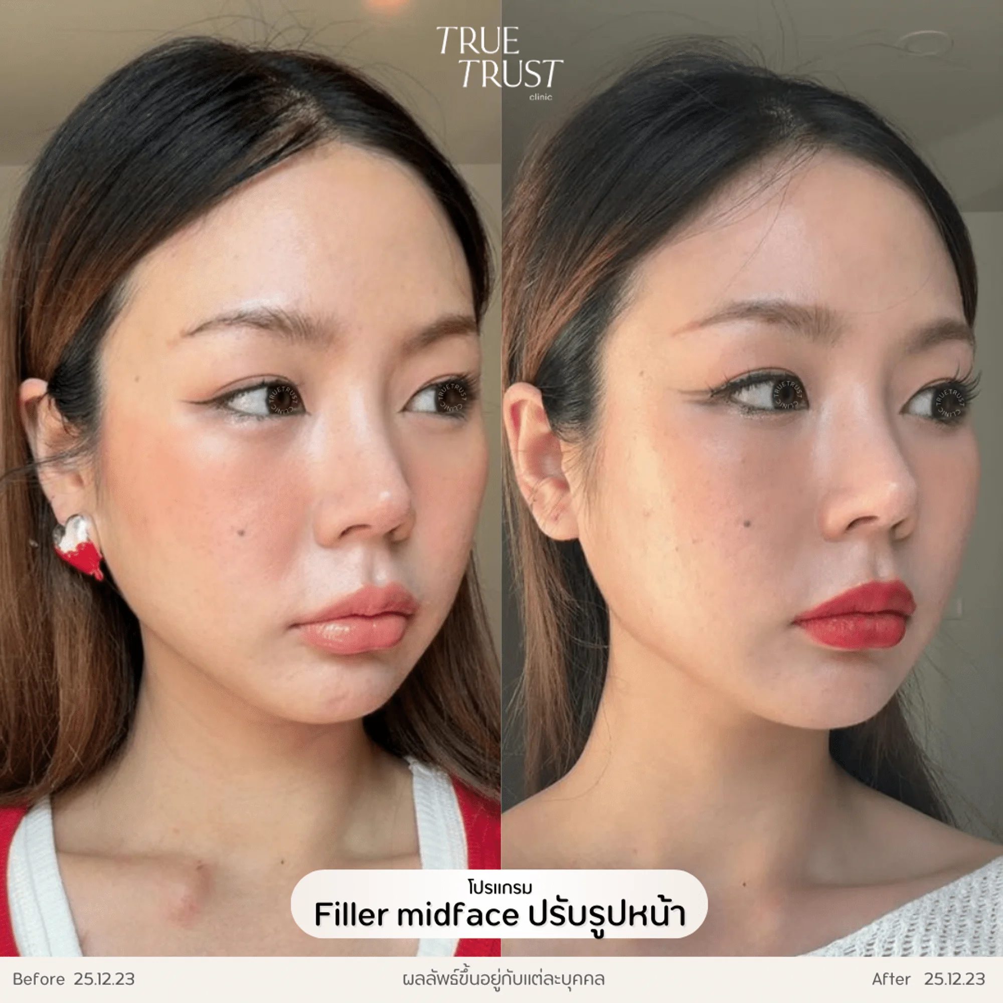 รีวิวฟิลเอลร์02