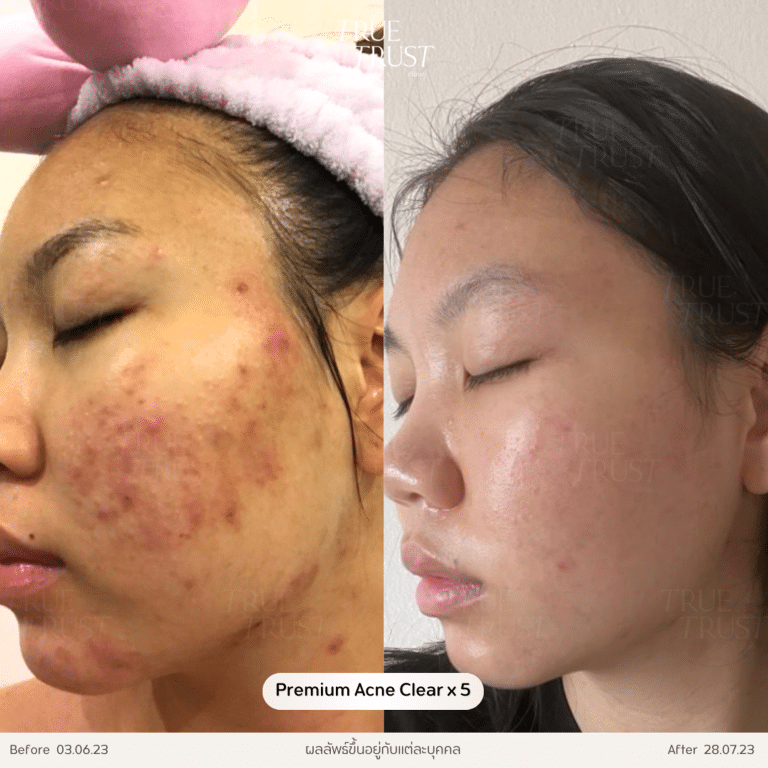 รีวิวรักษาสิว01