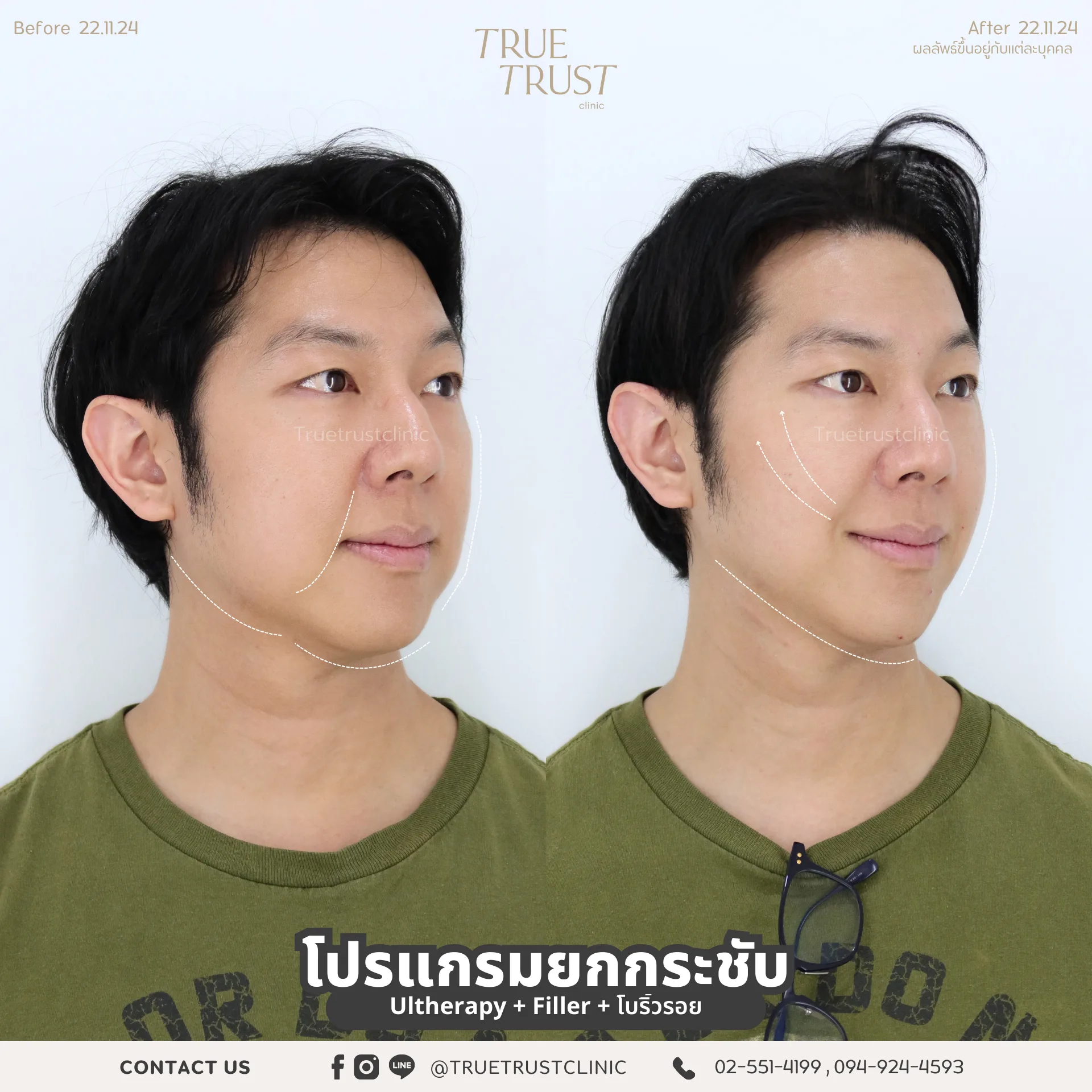 ฟิลเลอร์