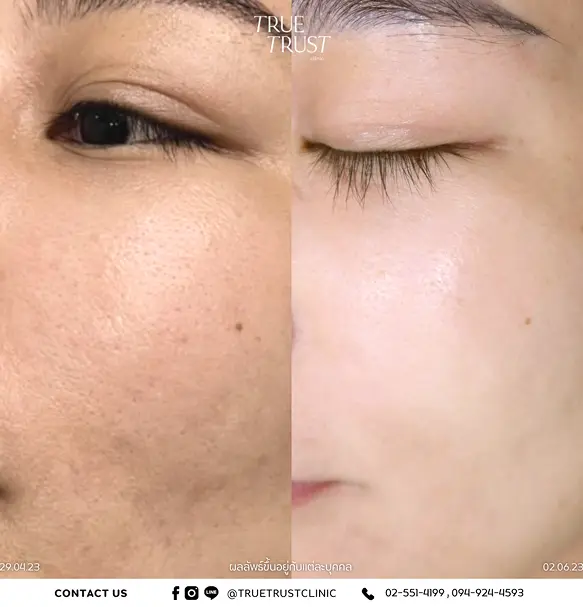 Review_skin-filter-set_1