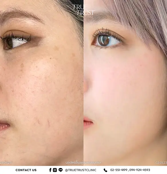 Review_skin-filter-set_2